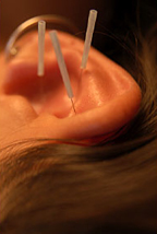 Palm Harbor Auricular Acupuncture / Palm Harbor Detoxification Acupuncturist