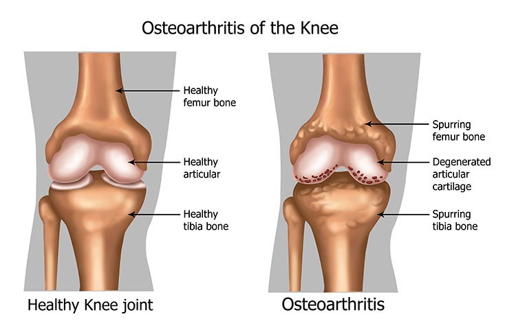 Osteoarthritis Pain Relief In Palm Harbor, FL - Palm Harbor Acupuncture Clinic