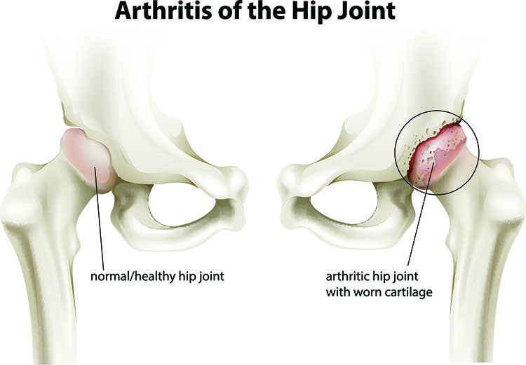 Arthritis Pain Relief In Palm Harbor, FL - Palm Harbor Acupuncture Clinic