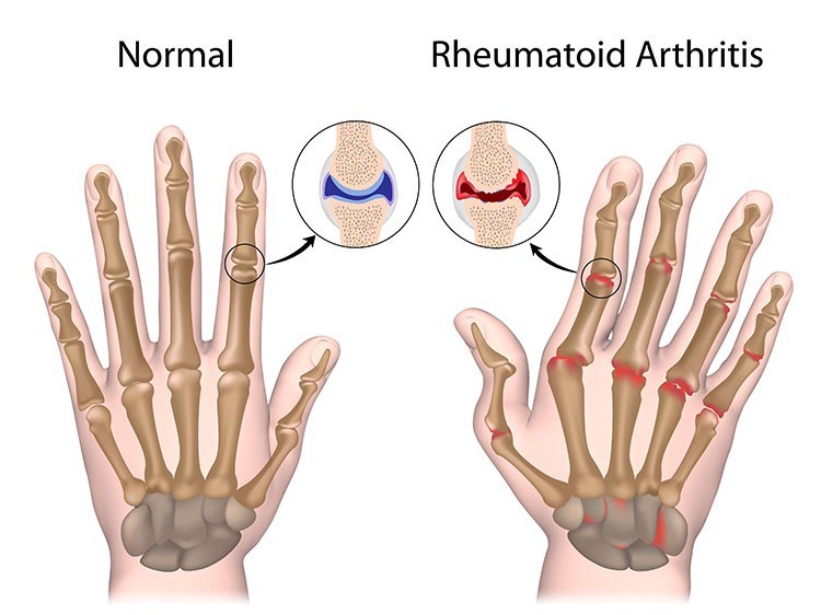 Rheumatoid Arthritis Pain Relief In Palm Harbor, FL - Palm Harbor Acupuncture Clinic